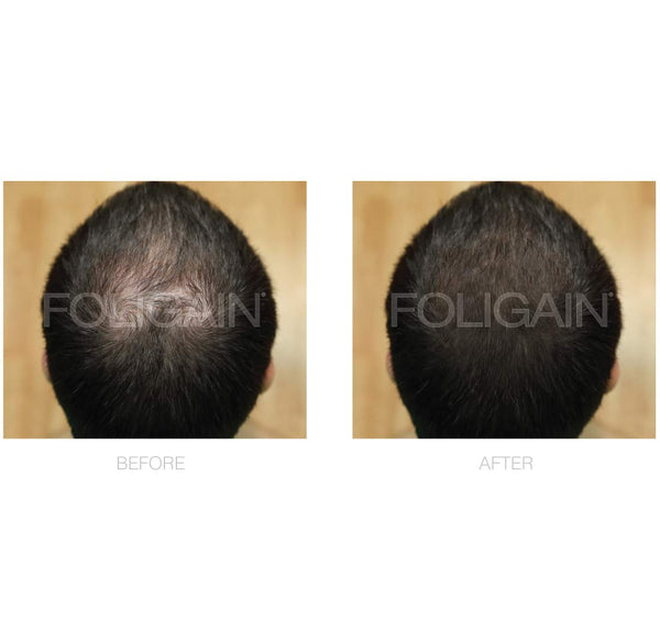 FOLIGAIN Minoxidil 5% Hair Regrowth Foam For Men 3 Month Supply - FOLIGAIN EU